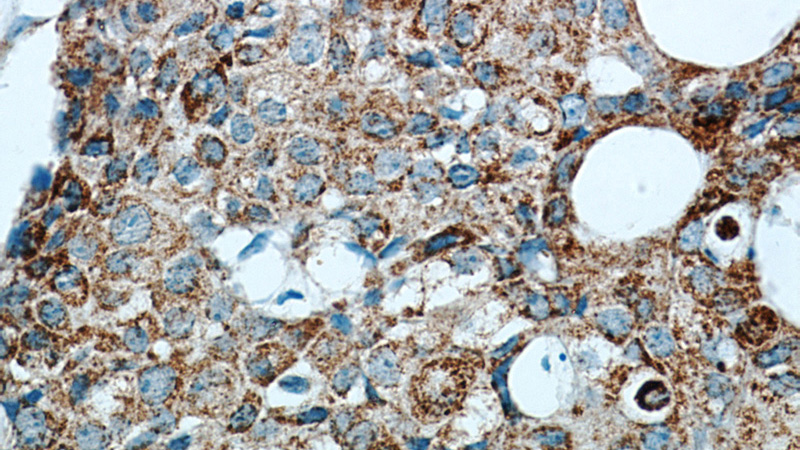Immunohistochemical of paraffin-embedded human breast cancer using Catalog No:110438(FABP3 antibody) at dilution of 1:50 (under 40x lens)