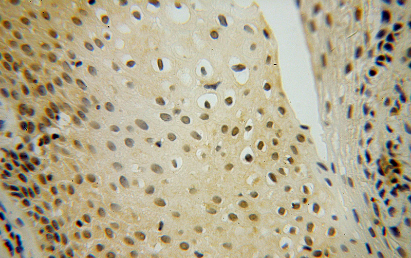 Immunohistochemical of paraffin-embedded human cervical cancer using Catalog No:111244(GTPBP4 antibody) at dilution of 1:100 (under 40x lens)