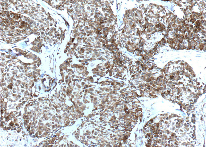 Immunohistochemistry of paraffin-embedded human lung cancer tissue slide using Catalog No:117105(Bcl-xL Antibody) at dilution of 1:200 (under 10x lens). heat mediated antigen retrieved with Tris-EDTA buffer(pH9).