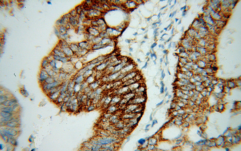 Immunohistochemical of paraffin-embedded human colon cancer using Catalog No:115820(SUCLG2 antibody) at dilution of 1:100 (under 40x lens)