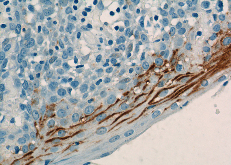 Immunohistochemistry of paraffin-embedded human tonsillitis tissue slide using Catalog No:112398(LY6D Antibody) at dilution of 1:50 (under 40x lens)