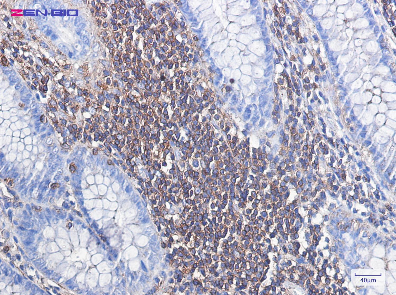Immunohistochemistry of Actin in paraffin-embedded Human colon cancer tissue using Actin Rabbit pAb at dilution 1/100