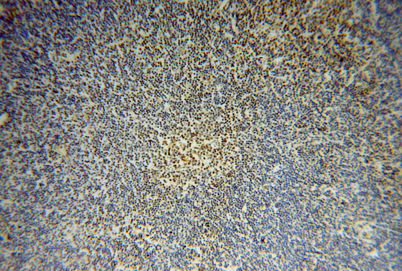 Immunohistochemical of paraffin-embedded human lymphoma using Catalog No:112826(MRPL37 antibody) at dilution of 1:50 (under 10x lens)