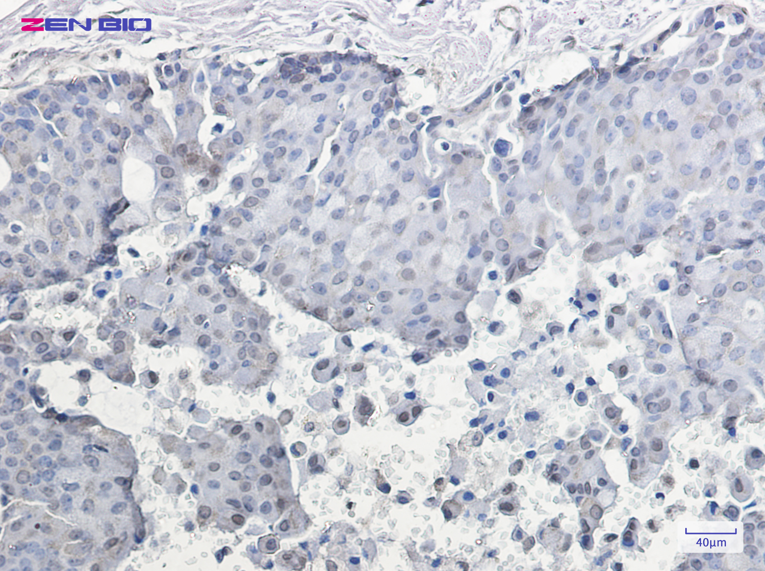 Immunohistochemistry of HSF1 (Phospho-Ser326) in paraffin-embedded Human breast cancer tissue using HSF1 (Phospho-Ser326) Rabbit pAb at dilution 1/20