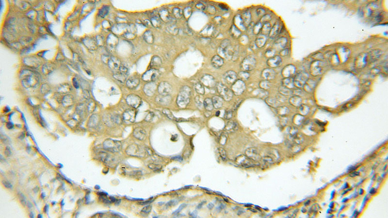 Immunohistochemical of paraffin-embedded human colon cancer using Catalog No:110085(DNAJA1 antibody) at dilution of 1:50 (under 25x lens)