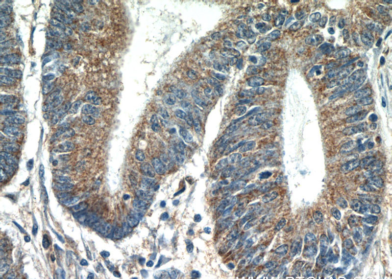 Immunohistochemistry of paraffin-embedded human colon cancer tissue slide using Catalog No:112836(MRPL55 Antibody) at dilution of 1:50 (under 40x lens)