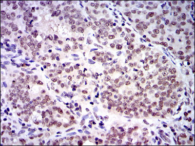 Immunohistochemical analysis of paraffin-embedded cervical cancer tissues using SKP1 mouse mAb with DAB staining.