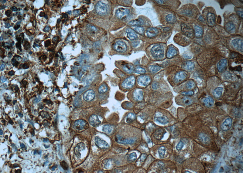 Immunohistochemistry of paraffin-embedded human lung cancer tissue slide using Catalog No:107366(KRAS Antibody) at dilution of 1:50 (under 40x lens)