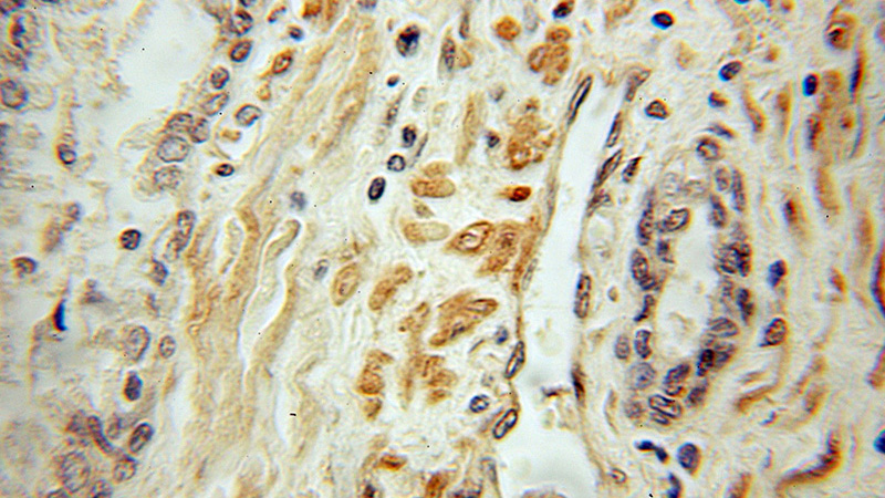 Immunohistochemical of paraffin-embedded human prostate cancer using Catalog No:112577(MECP2 antibody) at dilution of 1:50 (under 10x lens)