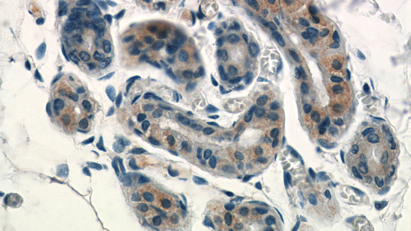 Immunohistochemistry of paraffin-embedded human skin tissue slide using Catalog No:115644(SPRR2D Antibody) at dilution of 1:50 (under 40x lens)