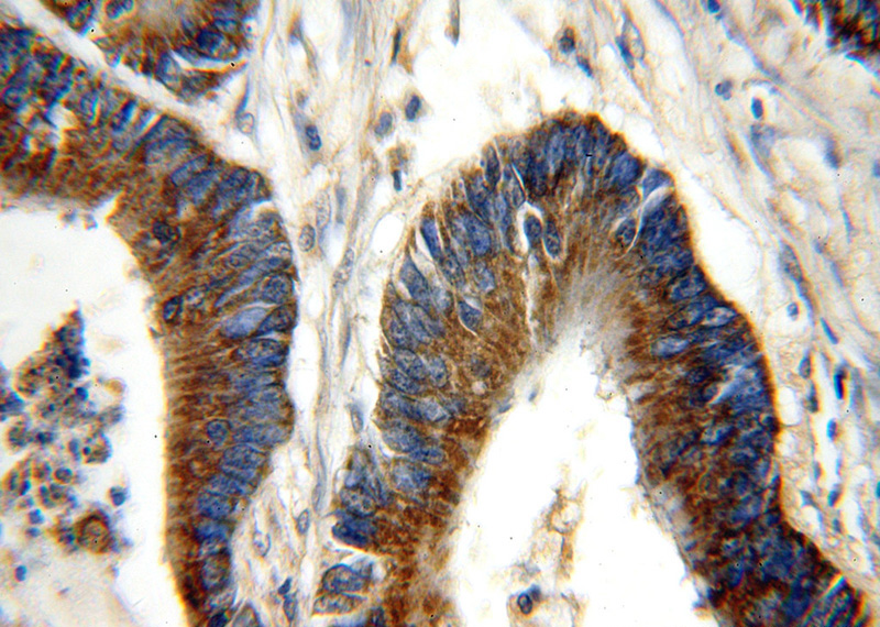 Immunohistochemical of paraffin-embedded human colon cancer using Catalog No:114387(PSMB7 antibody) at dilution of 1:50 (under 40x lens)