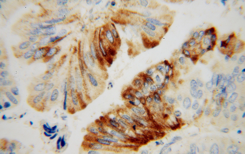 Immunohistochemical of paraffin-embedded human colon cancer using Catalog No:111604(IDH2 antibody) at dilution of 1:50 (under 40x lens)