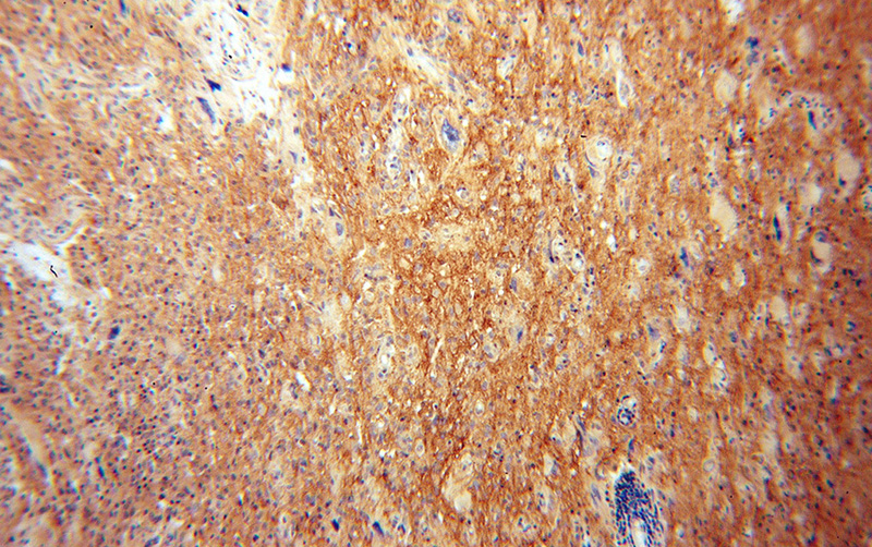 Immunohistochemical of paraffin-embedded human gliomas using Catalog No:113028(NCAM2 antibody) at dilution of 1:100 (under 10x lens)