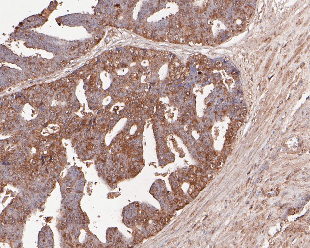 Fig2:; Immunohistochemical analysis of paraffin-embedded human prostate carcinoma tissue using anti-TNFRSF19 antibody. The section was pre-treated using heat mediated antigen retrieval with Tris-EDTA buffer (pH 8.0-8.4) for 20 minutes.The tissues were blocked in 5% BSA for 30 minutes at room temperature, washed with ddH; 2; O and PBS, and then probed with the primary antibody ( 1/200) for 30 minutes at room temperature. The detection was performed using an HRP conjugated compact polymer system. DAB was used as the chromogen. Tissues were counterstained with hematoxylin and mounted with DPX.