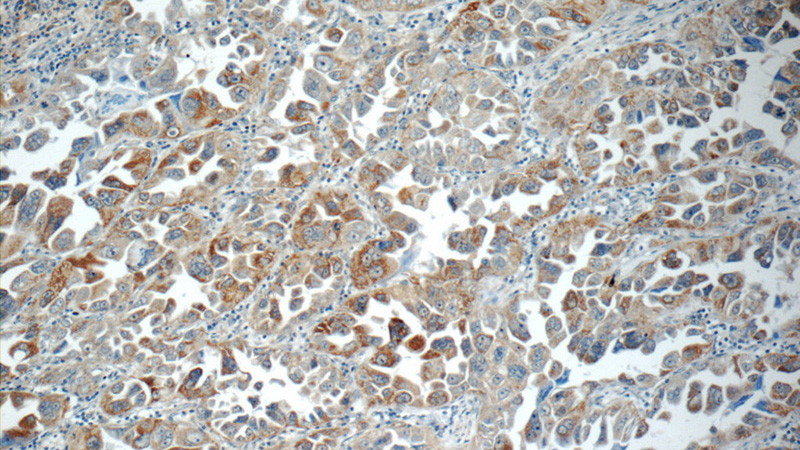 Immunohistochemistry of paraffin-embedded human lung cancer slide using Catalog No:116098(TMEM139 Antibody) at dilution of 1:50