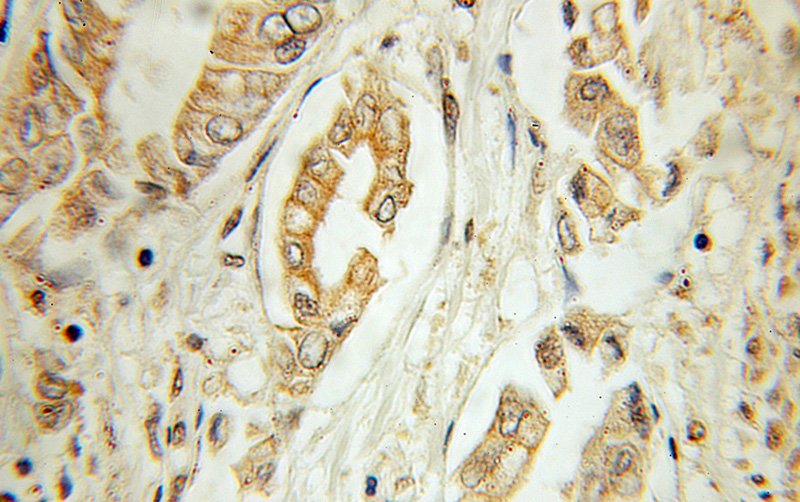 Immunohistochemical of paraffin-embedded human pancreas cancer using Catalog No:117185(BLK antibody) at dilution of 1:10 (under 10x lens)