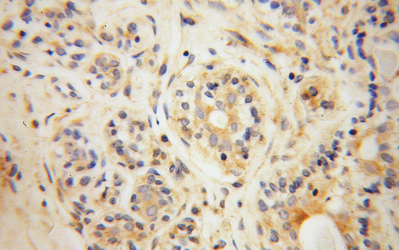 Immunohistochemical of paraffin-embedded human breast cancer using Catalog No:108165(ARPC2 antibody) at dilution of 1:100 (under 40x lens)