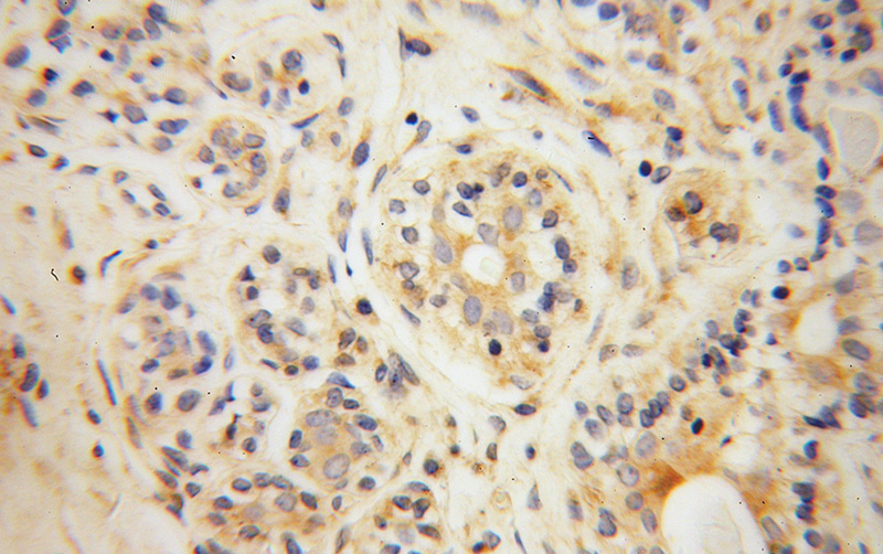 Immunohistochemical of paraffin-embedded human breast cancer using Catalog No:108165(ARPC2 antibody) at dilution of 1:100 (under 40x lens)