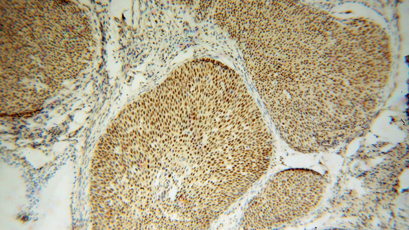 Immunohistochemical of paraffin-embedded human cervical cancer using Catalog No:111507(HNRNPH1 antibody) at dilution of 1:50 (under 10x lens)