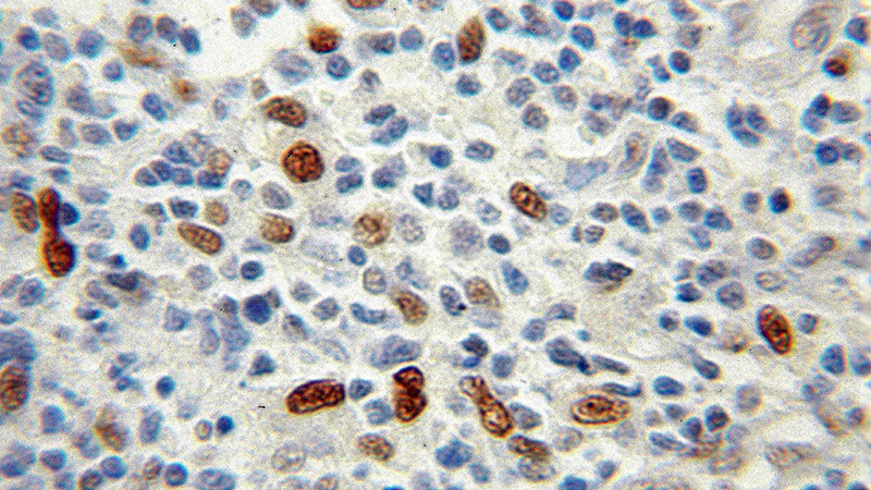 Immunohistochemical of paraffin-embedded human lymphoma using Catalog No:116336(TKT antibody) at dilution of 1:100 (under 10x lens)