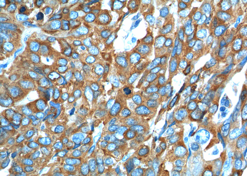 Immunohistochemistry of paraffin-embedded human ovary tumor tissue slide using Catalog No:111391(HE4 Antibody) at dilution of 1:100 (under 40x lens).