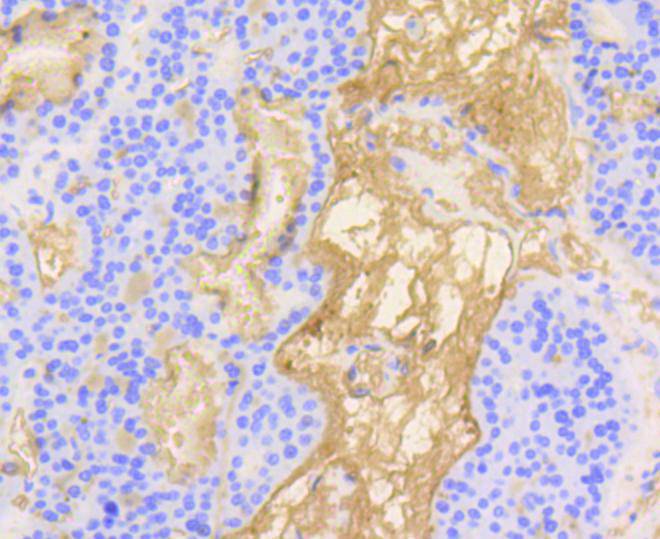 Fig7:; Immunohistochemical analysis of paraffin-embedded human liver carcinoma tissue using anti-Vitronectin antibody. The section was pre-treated using heat mediated antigen retrieval with Tris-EDTA buffer (pH 8.0-8.4) for 20 minutes.The tissues were blocked in 5% BSA for 30 minutes at room temperature, washed with ddH; 2; O and PBS, and then probed with the primary antibody ( 1/50) for 30 minutes at room temperature. The detection was performed using an HRP conjugated compact polymer system. DAB was used as the chromogen. Tissues were counterstained with hematoxylin and mounted with DPX.