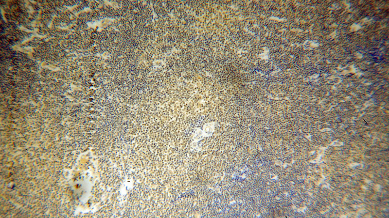 Immunohistochemical of paraffin-embedded human lymphoma using Catalog No:108879(CASP8 antibody) at dilution of 1:50 (under 10x lens)