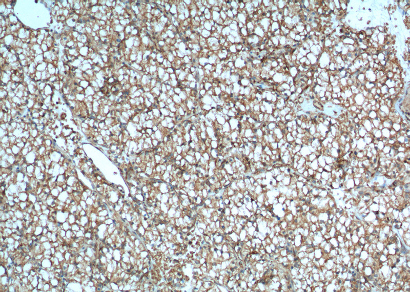 Immunohistochemistry of paraffin-embedded human renal cell carcinoma tissue slide using Catalog No:107030(CA9 Antibody) at dilution of 1:400 (under 10x lens). heat mediated antigen retrieved with Tris-EDTA buffer(pH9).