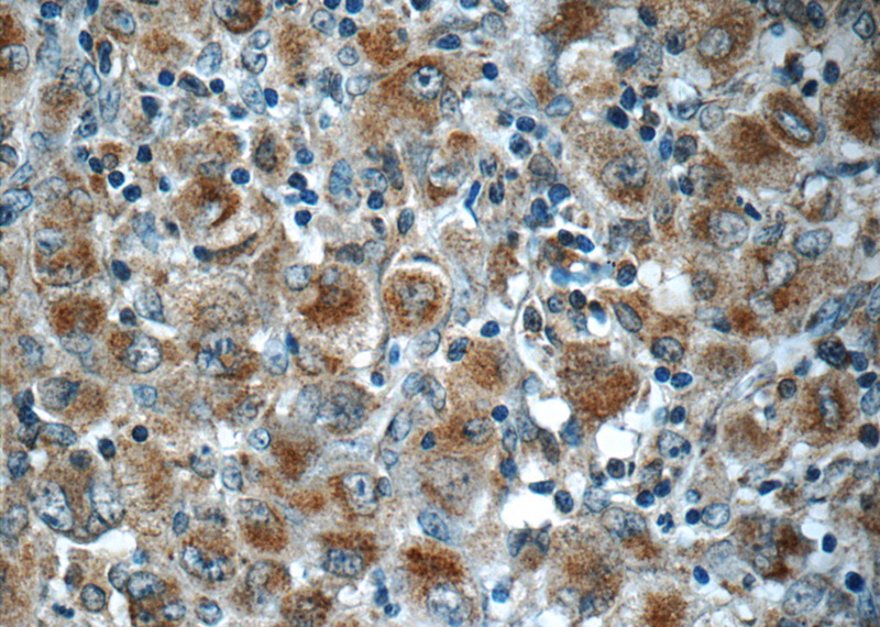 Immunohistochemistry of paraffin-embedded human lymphoma slide using Catalog No:114753(RNF213 Antibody) at dilution of 1:50