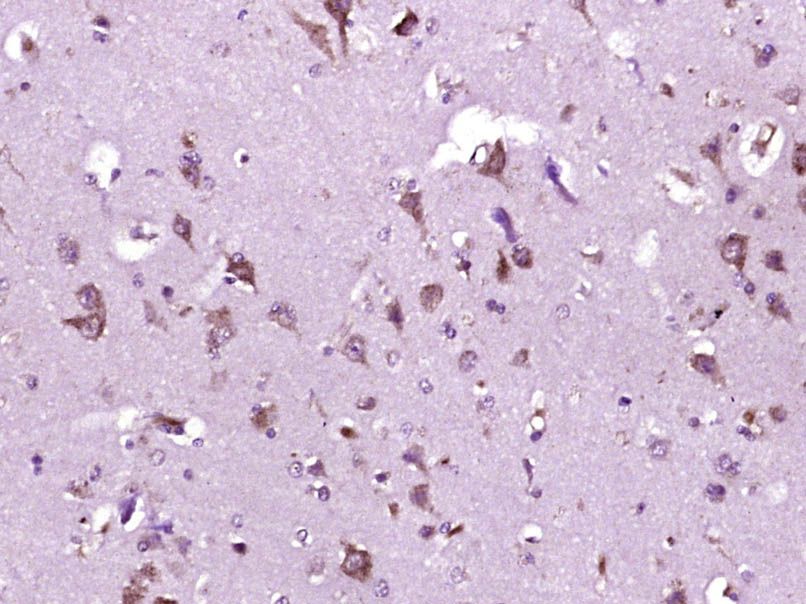 Fig1: Paraformaldehyde-fixed, paraffin embedded (Human brain glioma); Antigen retrieval by boiling in sodium citrate buffer (pH6.0) for 15min; Block endogenous peroxidase by 3% hydrogen peroxide for 20 minutes; Blocking buffer (normal goat serum) at 37℃ for 30min; Antibody incubation with (P2Y9) Polyclonal Antibody, Unconjugated at 1:400 overnight at 4℃, followed by operating according to SP Kit(Rabbit) (sp-0023) instructionsand DAB staining.