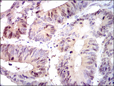 Immunohistochemical analysis of paraffin-embedded colon cancer tissues using PBK mouse mAb with DAB staining.