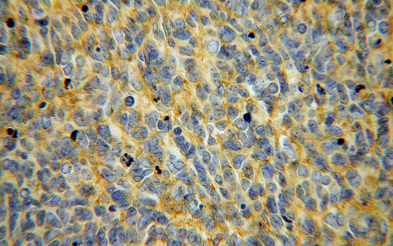 Immunohistochemical of paraffin-embedded human medulloblastoma using Catalog No:109017(CD276 antibody) at dilution of 1:100 (under 40x lens)
