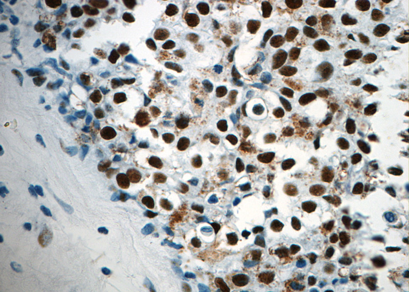 Immunohistochemistry of paraffin-embedded human breast cancer slide using Catalog No:108954(DBC1 Antibody) at dilution of 1:400