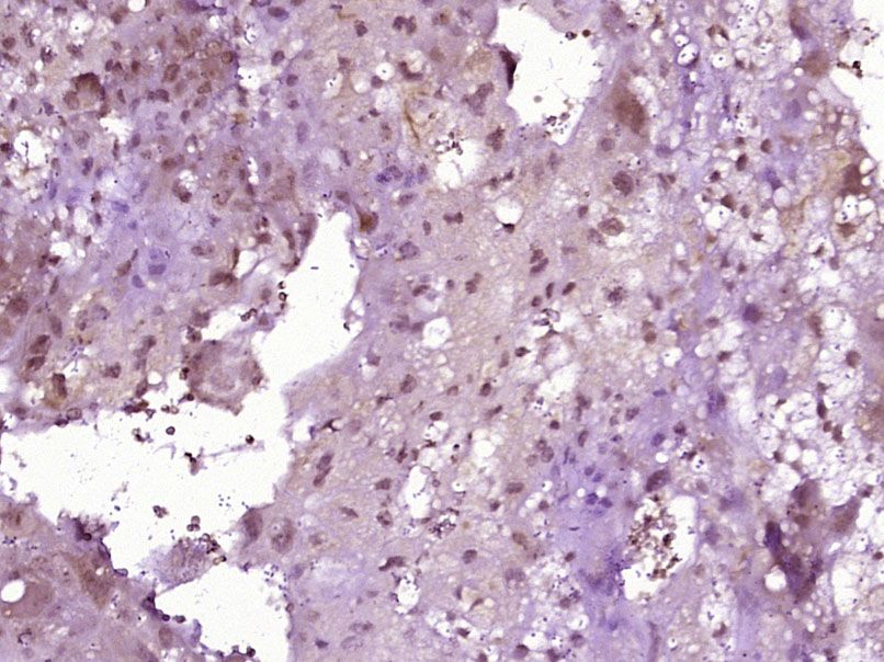 Fig2: Paraformaldehyde-fixed, paraffin embedded (Mouse placenta); Antigen retrieval by boiling in sodium citrate buffer (pH6.0) for 15min; Block endogenous peroxidase by 3% hydrogen peroxide for 20 minutes; Blocking buffer (normal goat serum) at 37℃ for 30min; Antibody incubation with (BarX2) Polyclonal Antibody, Unconjugated at 1:400 overnight at 4℃, followed by operating according to SP Kit(Rabbit) (sp-0023) instructionsand DAB staining.