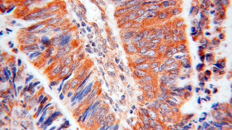 Immunohistochemical of paraffin-embedded human colon cancer using Catalog No:109570(DPYSL2 antibody) at dilution of 1:50 (under 40x lens)