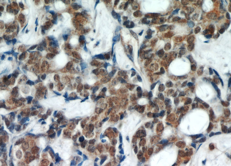 Immunohistochemical of paraffin-embedded human cervical cancer using Catalog No:107544(WTAP antibody) at dilution of 1:50 (under 40x lens)