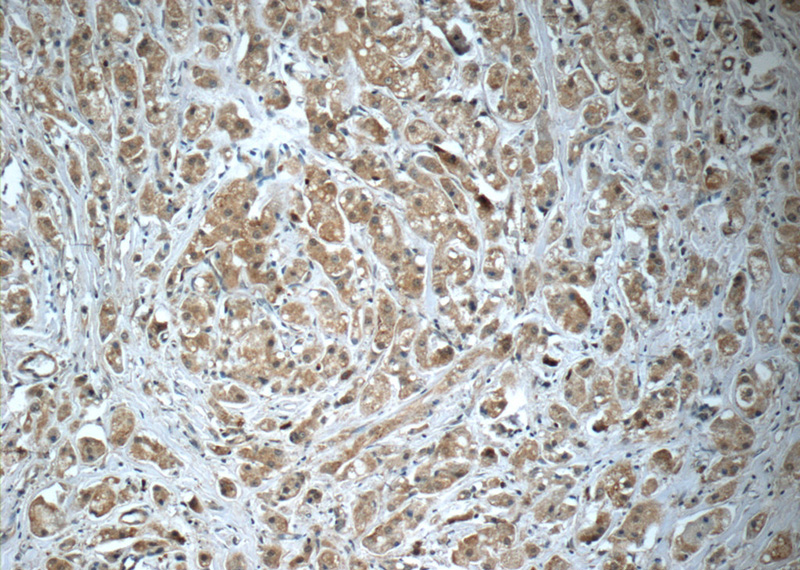 Immunohistochemistry of paraffin-embedded human breast cancer tissue slide using Catalog No:115658(SQLE Antibody) at dilution of 1:50 (under 10x lens)