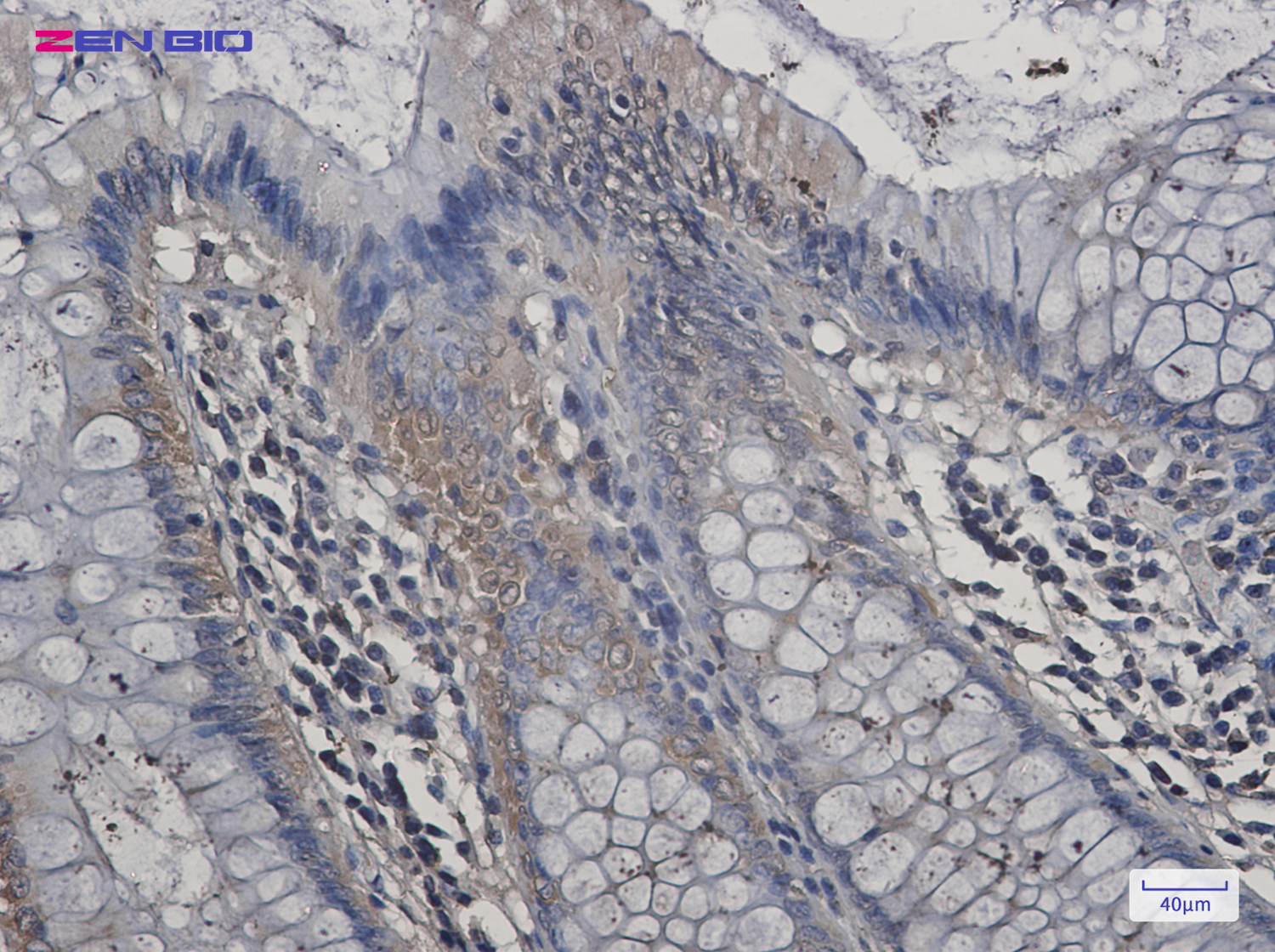 Immunohistochemistry of Aspartate Aminotransferase in paraffin-embedded Human colon cancer tissue using Aspartate Aminotransferase Rabbit pAb at dilution 1/20