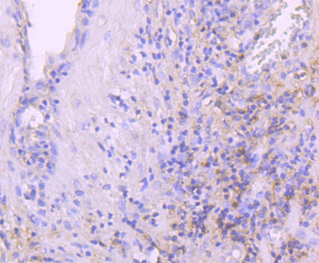 Fig6:; Immunohistochemical analysis of paraffin-embedded human prostate tissue using anti-Leptin Receptor antibody. The section was pre-treated using heat mediated antigen retrieval with Tris-EDTA buffer (pH 8.0-8.4) for 20 minutes.The tissues were blocked in 5% BSA for 30 minutes at room temperature, washed with ddH; 2; O and PBS, and then probed with the primary antibody ( 1/50) for 30 minutes at room temperature. The detection was performed using an HRP conjugated compact polymer system. DAB was used as the chromogen. Tissues were counterstained with hematoxylin and mounted with DPX.