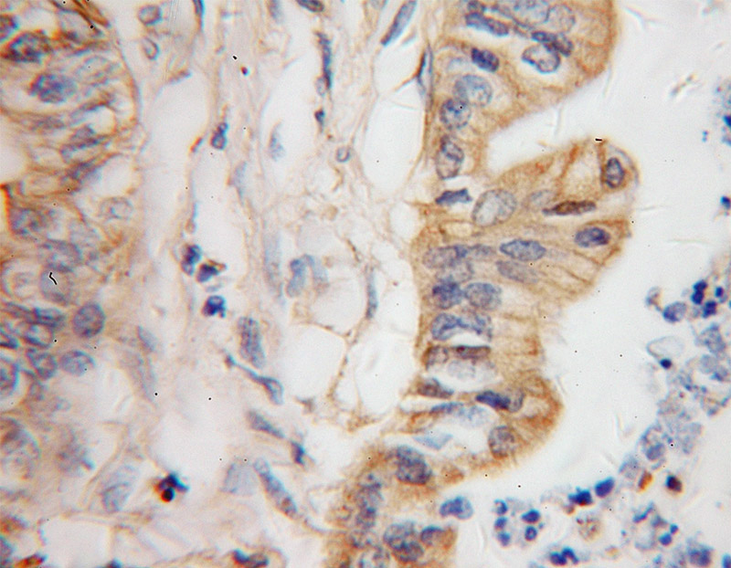 Immunohistochemical of paraffin-embedded human pancreas cancer using Catalog No:110927(GDI2 antibody) at dilution of 1:10 (under 40x lens)