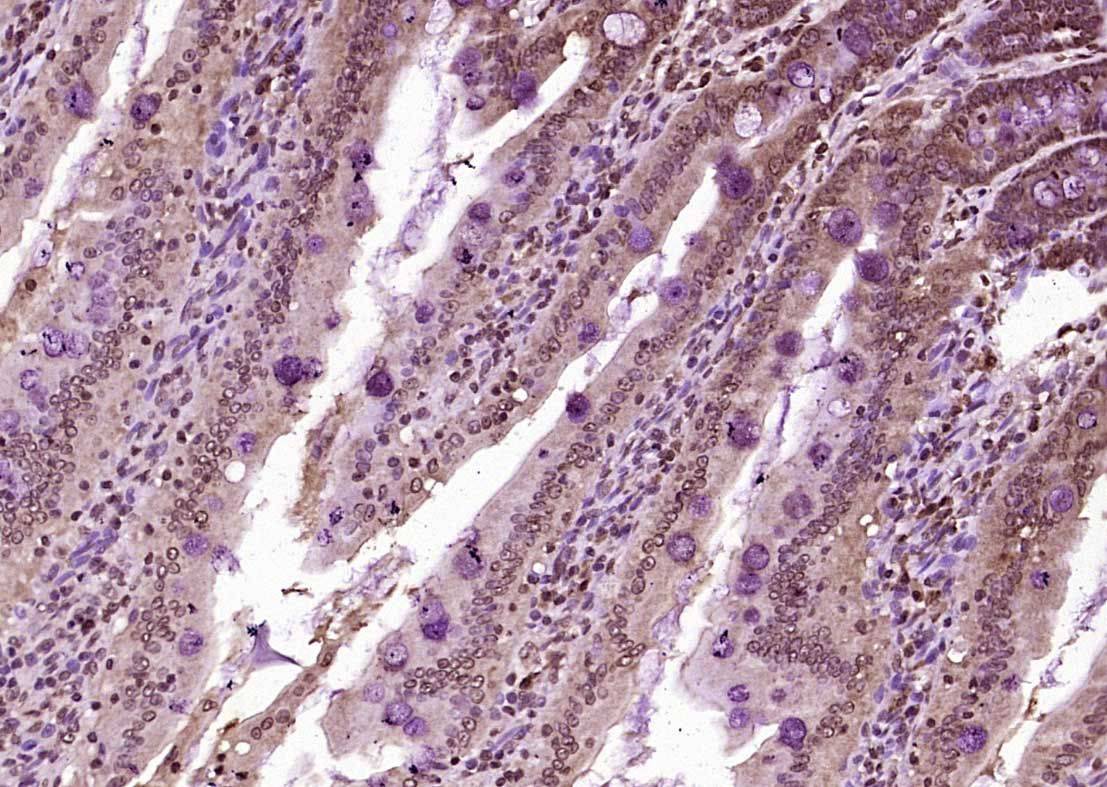Fig3: Paraformaldehyde-fixed, paraffin embedded (Rat small intestine); Antigen retrieval by boiling in sodium citrate buffer (pH6.0) for 15min; Block endogenous peroxidase by 3% hydrogen peroxide for 20 minutes; Blocking buffer (normal goat serum) at 37℃ for 30min; Antibody incubation with (KIBRA) Polyclonal Antibody, Unconjugated at 1:400 overnight at 4℃, followed by operating according to SP Kit(Rabbit) (sp-0023) instructionsand DAB staining.