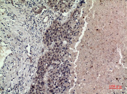 Fig2:; Immunohistochemical analysis of paraffin-embedded human-lung, antibody was diluted at 1:100