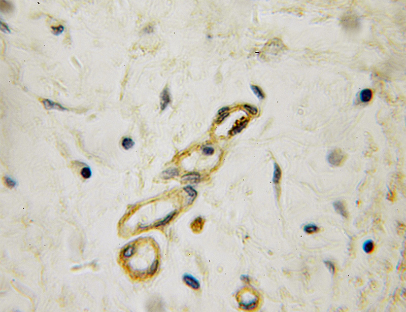 Immunohistochemical of paraffin-embedded human pancreas cancer using Catalog No:114105(PPP2R5A antibody) at dilution of 1:50 (under 10x lens)