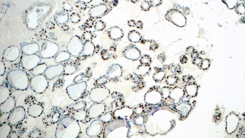 Immunohistochemistry of paraffin-embedded human thyroid tissue slide using Catalog No:111094(GMCL1 Antibody) at dilution of 1:50