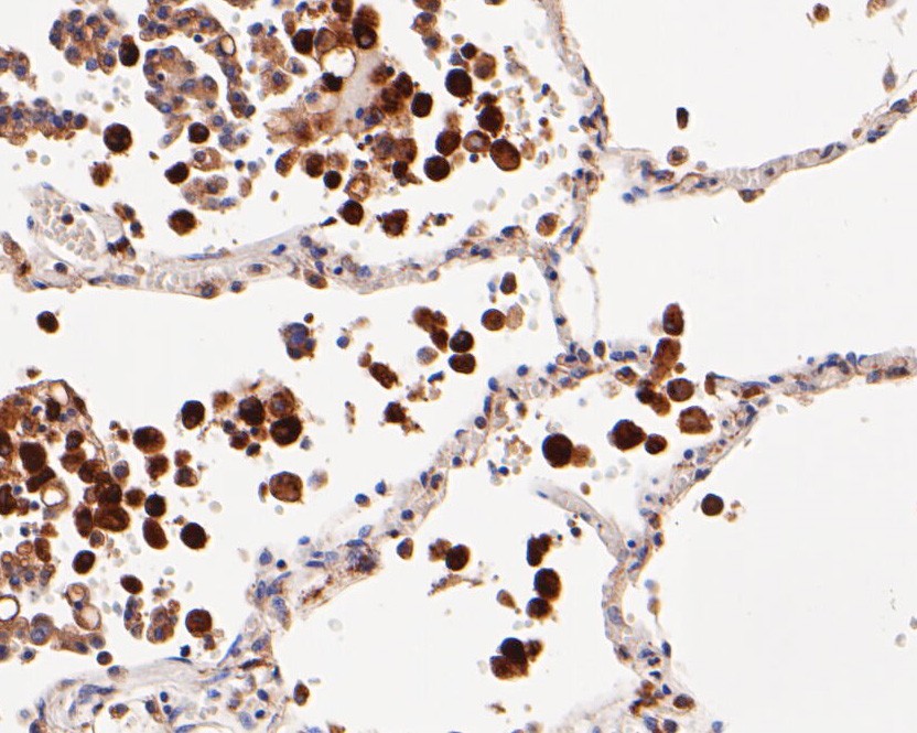 Fig4:; Immunohistochemical analysis of paraffin-embedded human lung tissue using anti-CD68 antibody. The section was pre-treated using heat mediated antigen retrieval with Tris-EDTA buffer (pH 8.0-8.4) for 20 minutes.The tissues were blocked in 5% BSA for 30 minutes at room temperature, washed with ddH; 2; O and PBS, and then probed with the primary antibody ( 1/200) for 30 minutes at room temperature. The detection was performed using an HRP conjugated compact polymer system. DAB was used as the chromogen. Tissues were counterstained with hematoxylin and mounted with DPX.