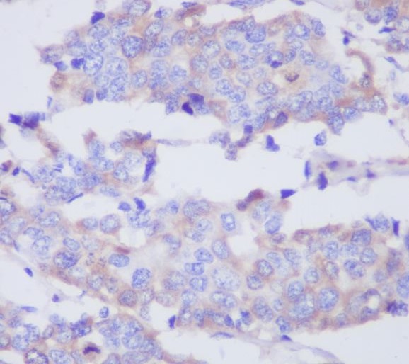 Immunohistochemical analysis of paraffin-embedded human breast adenocarcinoma, using MMP2 Antibody.