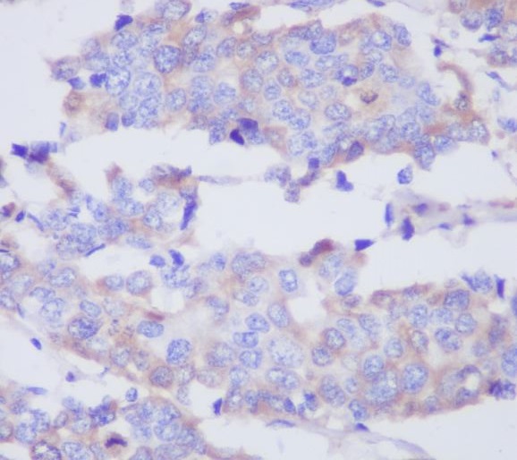 Immunohistochemical analysis of paraffin-embedded human breast adenocarcinoma, using MMP2 Antibody.