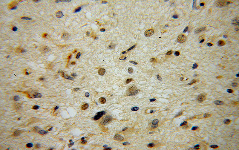 Immunohistochemical of paraffin-embedded human gliomas using Catalog No:108923(CAMKK1 antibody) at dilution of 1:50 (under 40x lens)