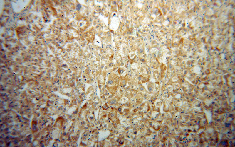 Immunohistochemical of paraffin-embedded human liver cancer using Catalog No:111341(HIBCH antibody) at dilution of 1:100 (under 10x lens)