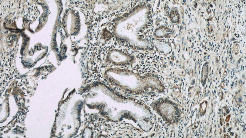 Immunohistochemistry of paraffin-embedded human pancreas cancer slide using Catalog No:116766(VNN1 Antibody) at dilution of 1:50(under 10x lens)